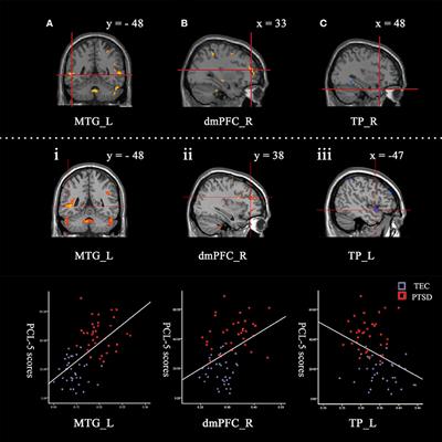 Altered Gray Matter Volume and Its Correlation With PTSD Severity in Chinese Earthquake Survivors